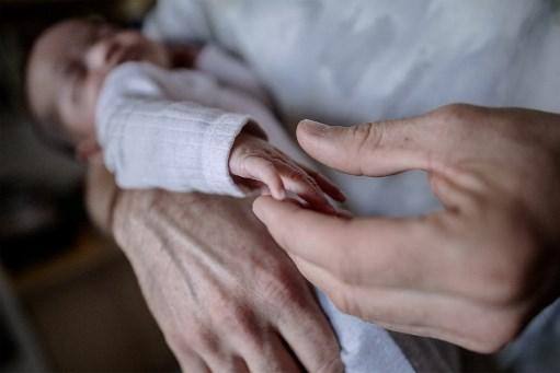 Bebê nasce com terceira mão nas costas; veja a foto