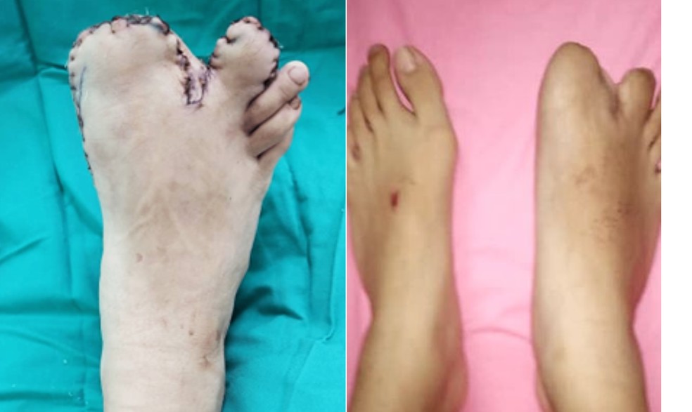 Para melhorar a funcionalidade do pé da menina e eliminar a possibilidade de problemas futuros, a equipa médica local realizou uma operação de reconstrução — Foto: Cureus