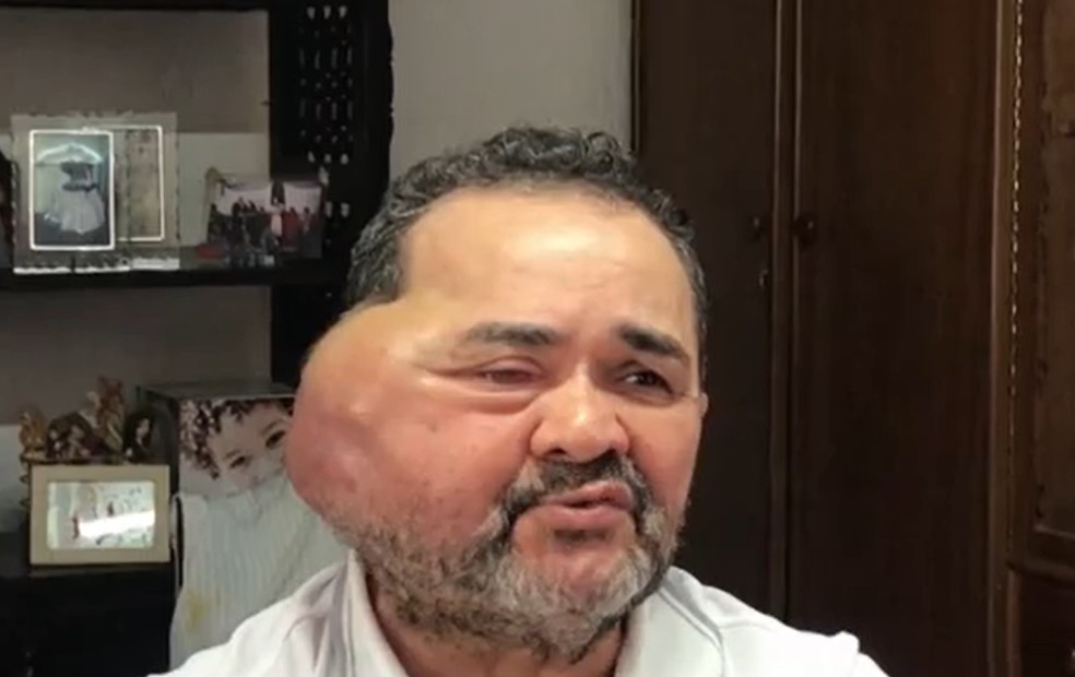 José Nilton Cardozo tem meningioma e luta para fazer cirurgia no rosto — Foto: Divulgação