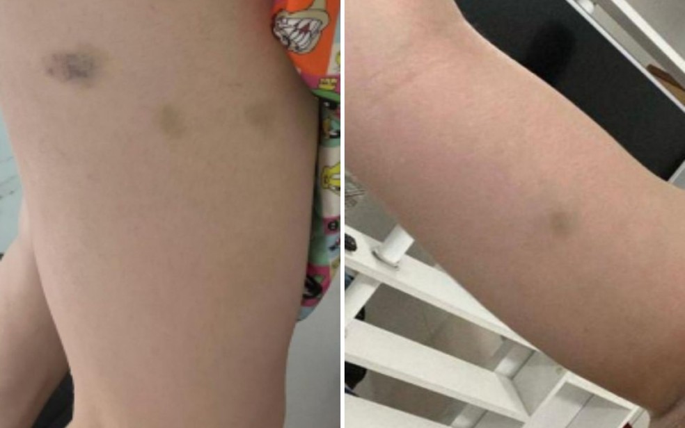 Caso Naiara Azevedo: fotos mostram hematomas no corpo da cantora após denúncia de agressão contra ex-marido — Foto: Reprodução